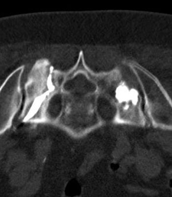 Sakroplastie 4 (Zement)